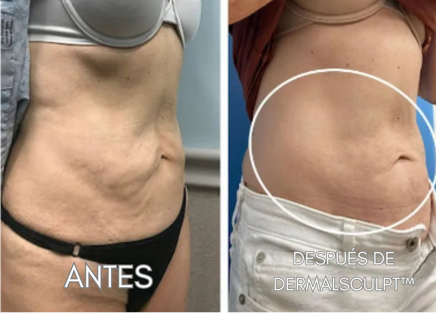 DERMALSCULPT™